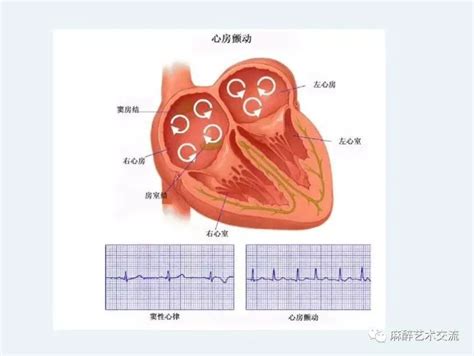 心房颤动,心室扑动,心房颤动的心电图特点_大山谷图库