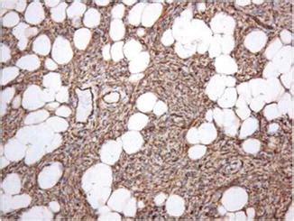 Dermatofibrosarcoma Protuberans | Plastic Surgery Key