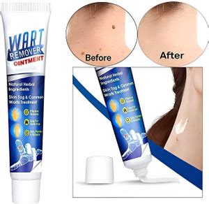 YAWI Best Mole Wart Remover Cream, Massa Removal Cream - Price in India ...