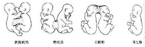 双胎、多胎和联胎_《组织学与胚胎学》_【中医宝典大全】