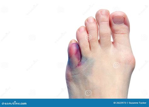 Bruises, Bunions, Broken Toes Stock Image - Image of aging, abnormality: 2622973