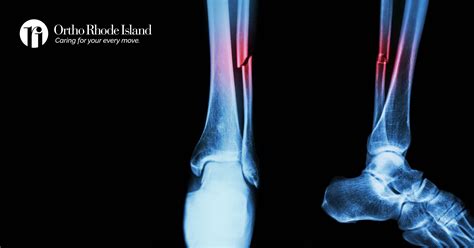 Does Heat Help Heal Fractures at Ronald Alvarez blog