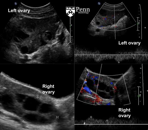 Ovarian Torsion Ultrasound