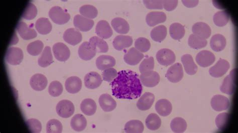 Immature Granulocytes Count Testing 101: Who To Test & How To ...
