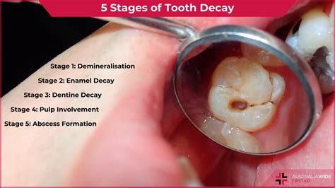 Cavity Molar HOW TO Clean Up Severe Occlusal Decay On TOOTH #31: 1 Of