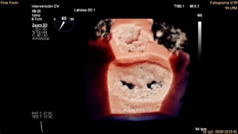 El Instituto del Corazón Teknon ofrece intervenciones mínimamente ...