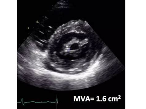 Echo Mitral Stenosis | PPTX