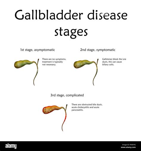 Gallbladder disease stages, illustration. The stages include inflammation and gallstone ...