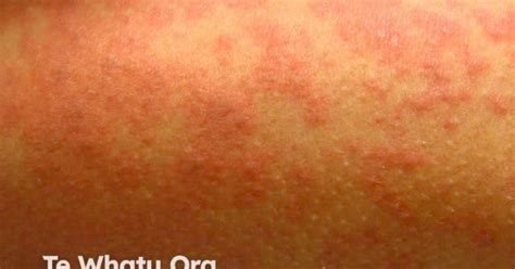 Rash Pictures SJS 的图像结果