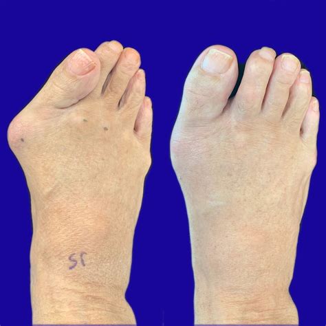 Before and After Bunion Surgery Photos | The Bunion Cure