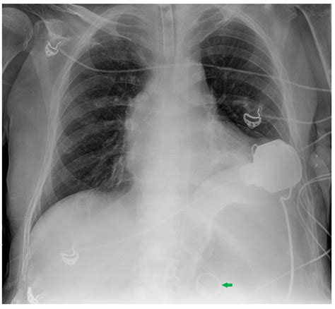 Chest X-ray Interpretation: Detecting Devices and Device-Related ...