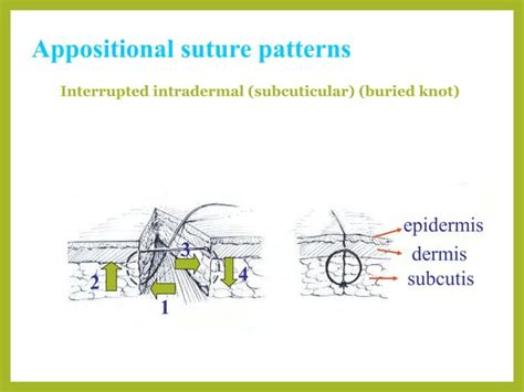 Image result for Continuous Suture Patterns