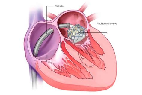 Pacemaker Procedure 的图像结果