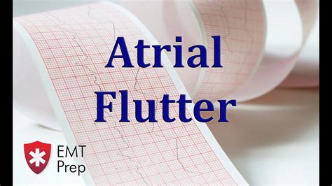 Image result for Atrial Flutter ECG Pattern