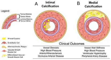 Targeting a Silent Disease: Vascular Calcification in Chronic Kidney ...