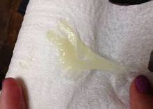 Yellow Discharge After Period - Causes & When to See a Doctor ...