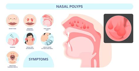 An Expert Offers Important Facts and Advice on Living with Nasal Polyps ...