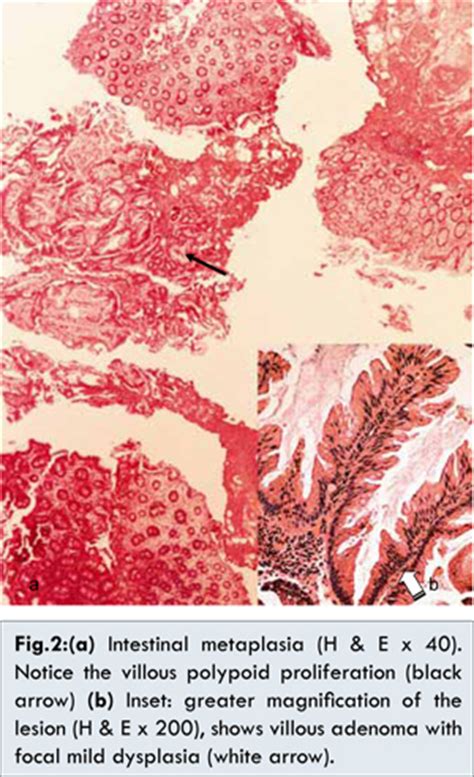 Villous Adenoma Arising Within Intestinal Metaplasia on the Bladder Dome