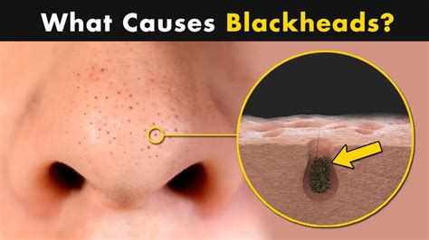 Image result for Largest Infected Exploding Cyst Carbuncle Blackhead