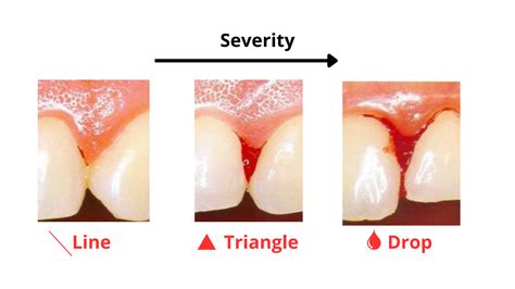 How to Stop Gum Bleeding at Home immediately (5 tips)