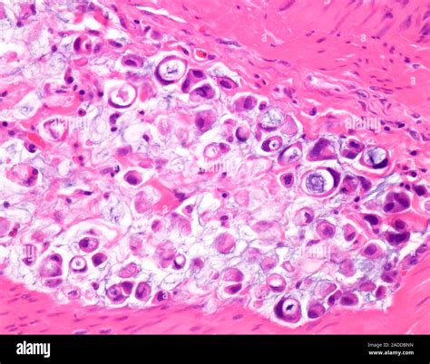 Signet ring cell carcinoma of the colon, light micrograph. This is a rare form of adenocarcinoma ...