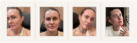 Image result for Thread Brow Lift Procedure