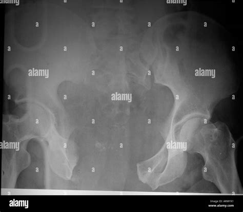 Symphysis High Resolution Stock Photography and Images - Alamy