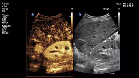 Liver Ultrasound – Products & Services - Philips