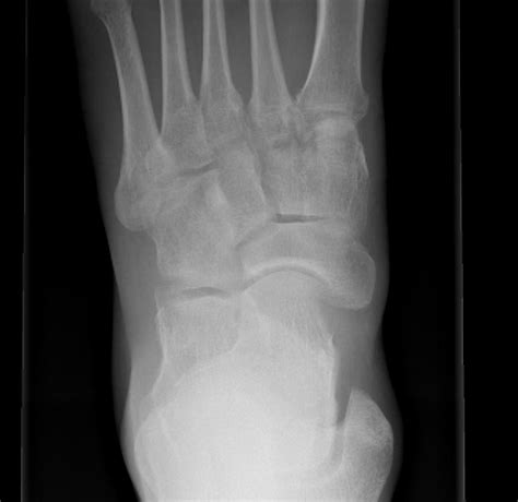 Accessory Navicular File:Acessory Navicular Bone 2.jpg Wikimedia