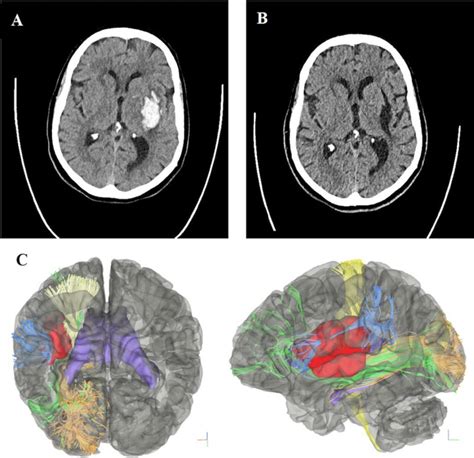 Minimally invasive surgery and transsulcal parafascicular approach in the evacuation of ...