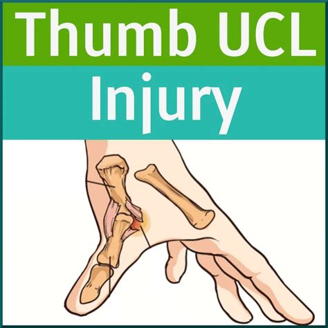 Ulnar Collateral Ligament of the Thumb Injury - Sports Medicine Review