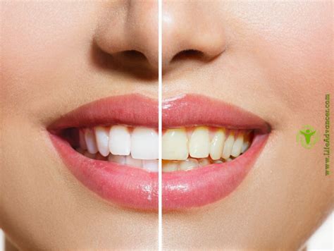 Image result for Tooth Whitening Tips