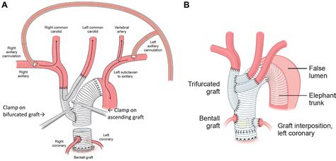 Complex Bentall Operation: Clinical Pearls to Standardize the Procedure ...
