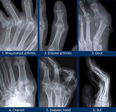 Osteoarthritis Vs Rheumatoid Arthritis Hands
