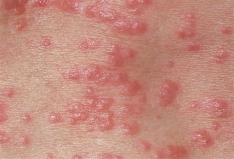 Which Skin Cream Takes Care of Rashes and Bug Bite – Bipha Ayurveda