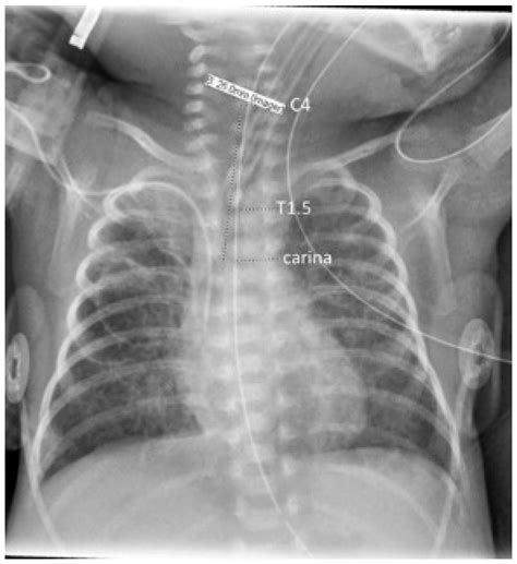 Tracheal Length Measurement in Intubated Neonates to Guide the Design ...