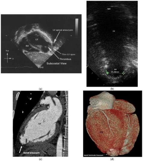 Children | Special Issue : Clinic Research on Kawasaki Disease in Children