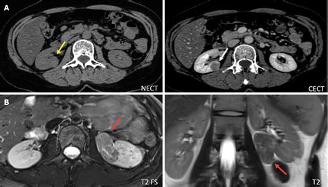 Renal angiomyolipomas: Typical and atypical features on computed tomography and magnetic ...