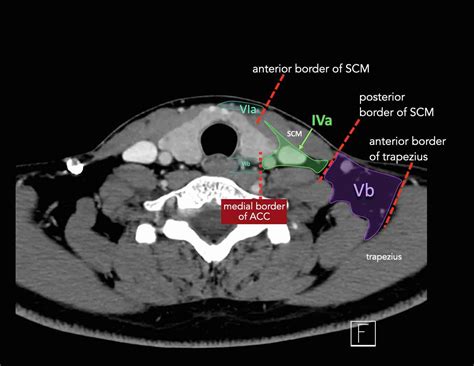 Ct Neck Levels Radiology at Pamela Ottley blog