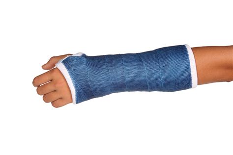 Fractured Wrist Cast