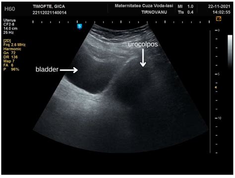 Bladder Outlet Obstruction Due to Recurrent Complete Labial Fusion in ...