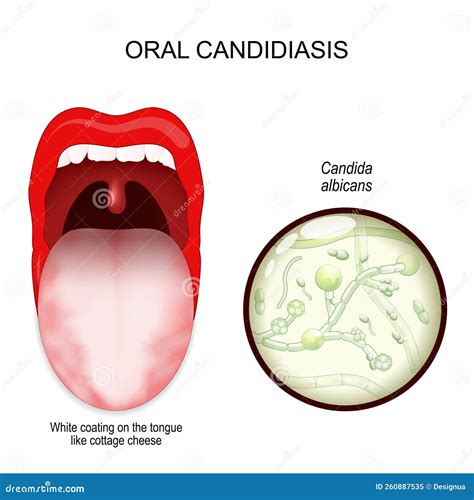 Candida Throat Treatment : What Is Invasive Candidiasis? Causes, Diagnosis, and Treatment – JPNQ
