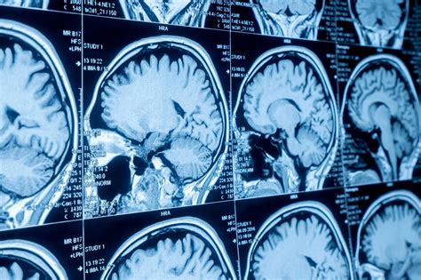 Hidden Brain Lesions Uncovered by AI, Transforming Epilepsy Treatment