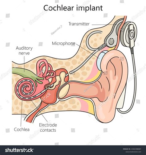 Cochlear Implant Diagram Cochlear Implant An Overview