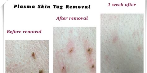Plasma Skin Tag and Mole Removal - Eternal Beauty Lisburn