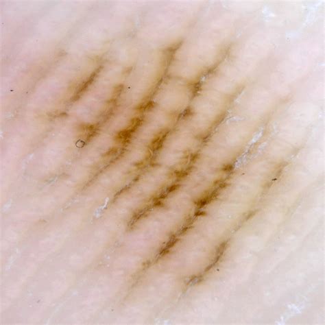 Moles on the soles of the feet and palms of the hands