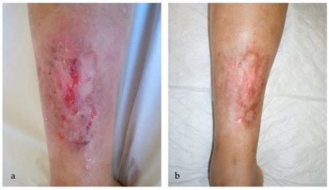 Shedding Light on Photodynamic Therapy in the Treatment of Necrobiosis ...