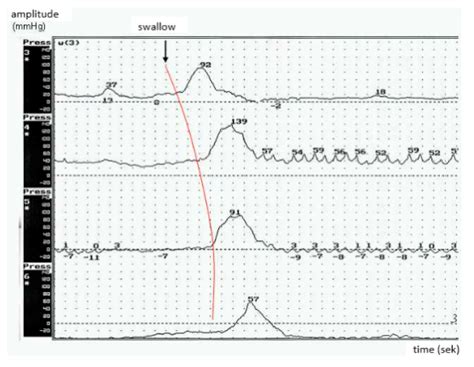 Esophageal Peristalsis Disorders in ALS Patients with Dysphagia