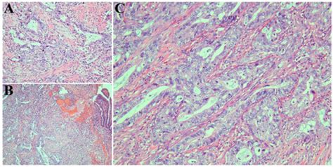 Nab-Paclitaxel and Gemcitabine as First-Line Treatment of Metastatic ...