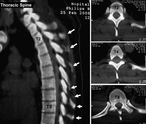 Multiple isolated thoracic spinous process fractures (Clay-Shoveler’s fracture) - The Spine Journal